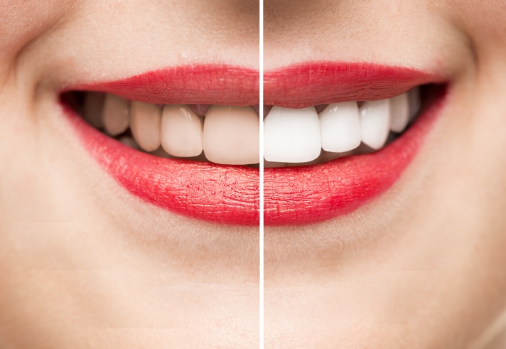 Teeth After and Before Whitening high quality studio shot