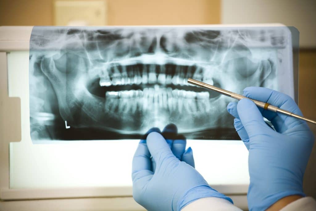 Pickering Root Canal Therapy