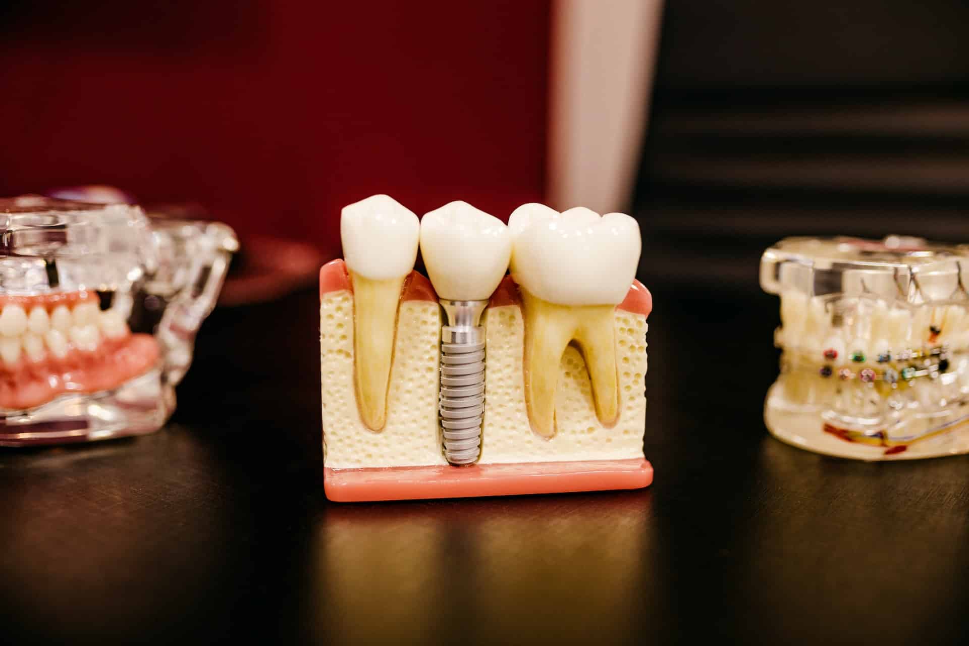 Dental implant