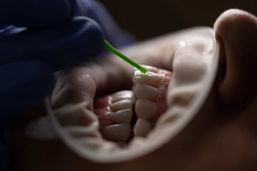 teeth whitening