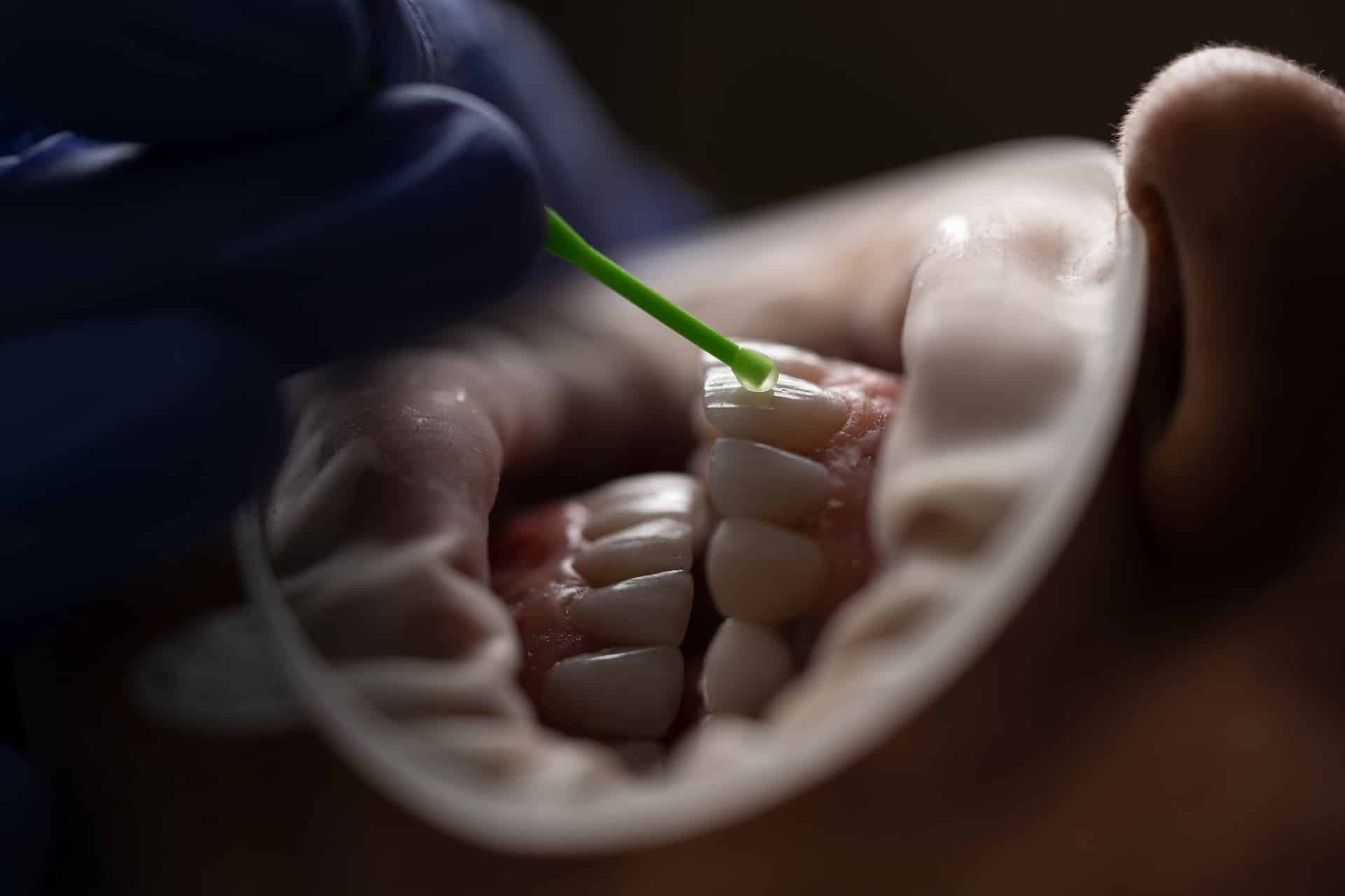 teeth whitening