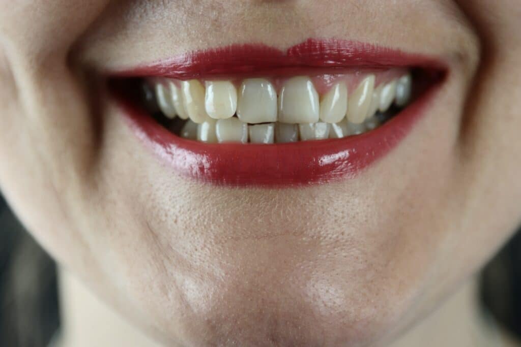 Teeth Discolouration