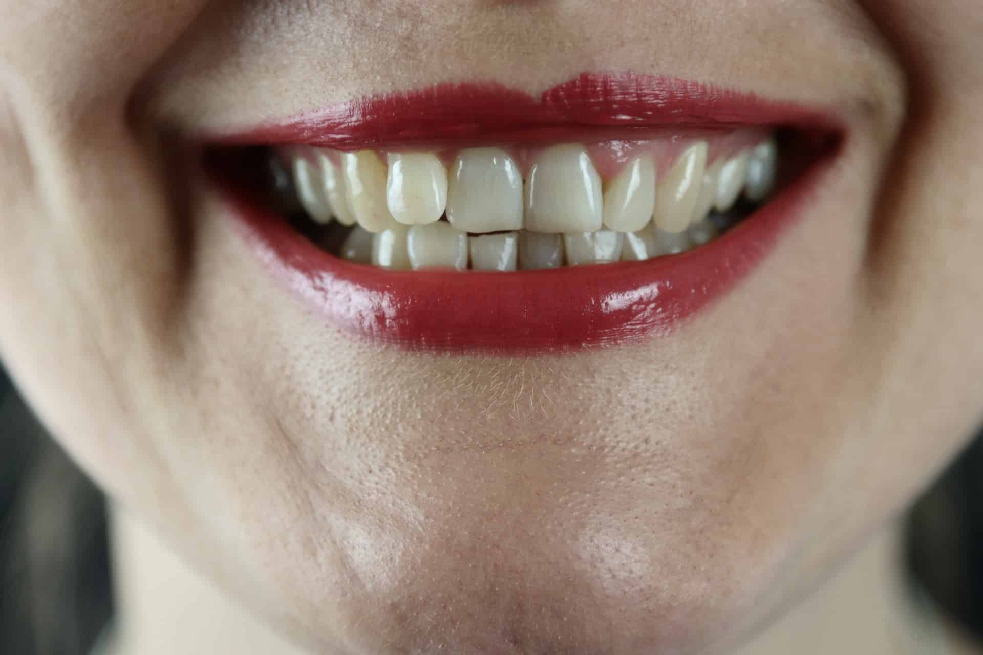 Teeth Discolouration