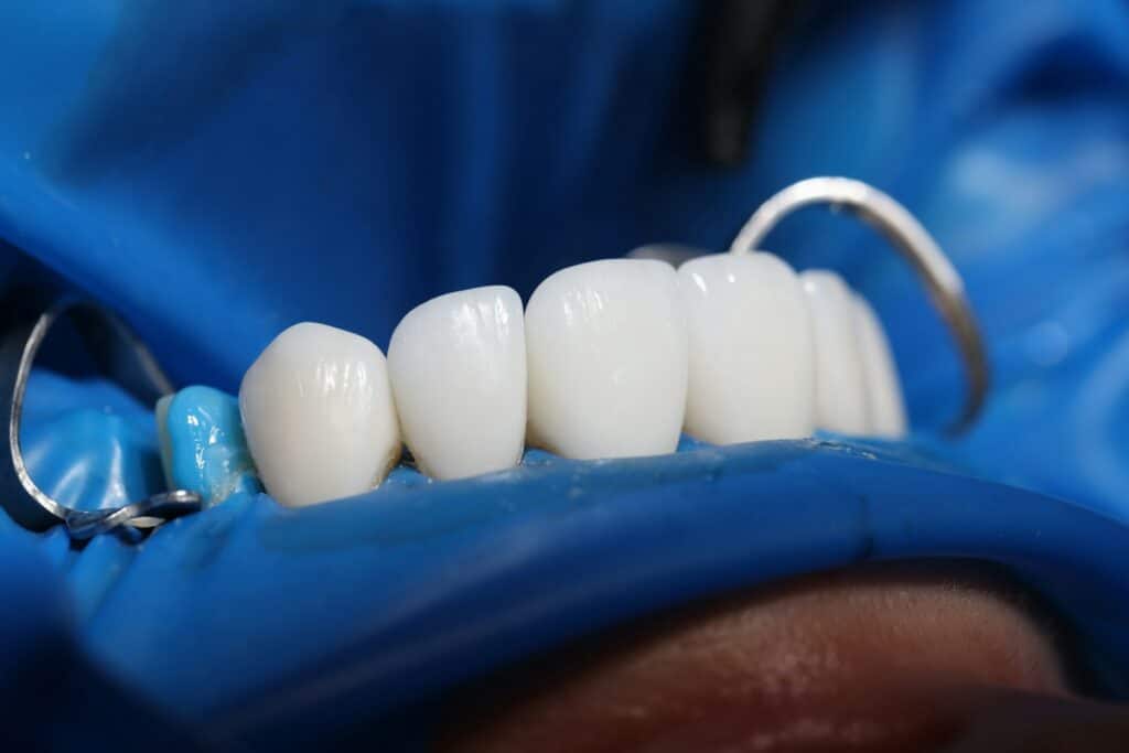 dental veneer
