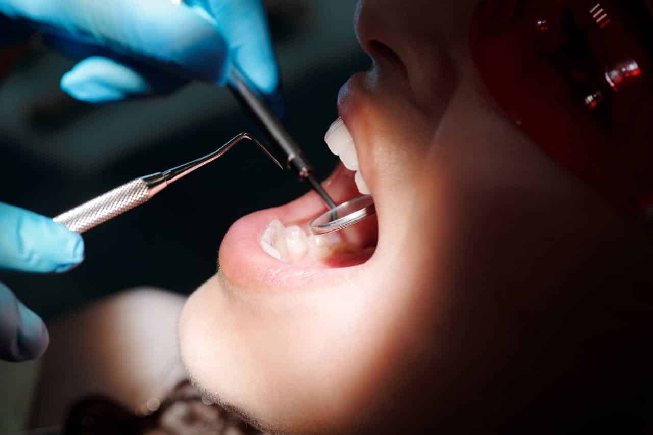 tooth coloured fillings