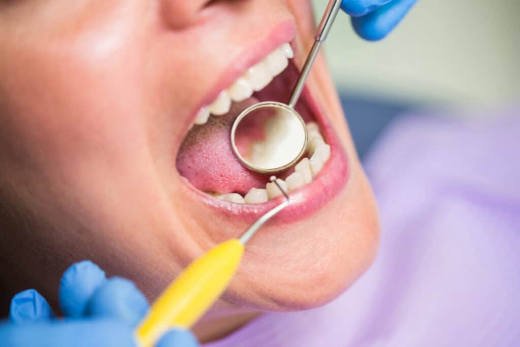 tooth coloured fillings
