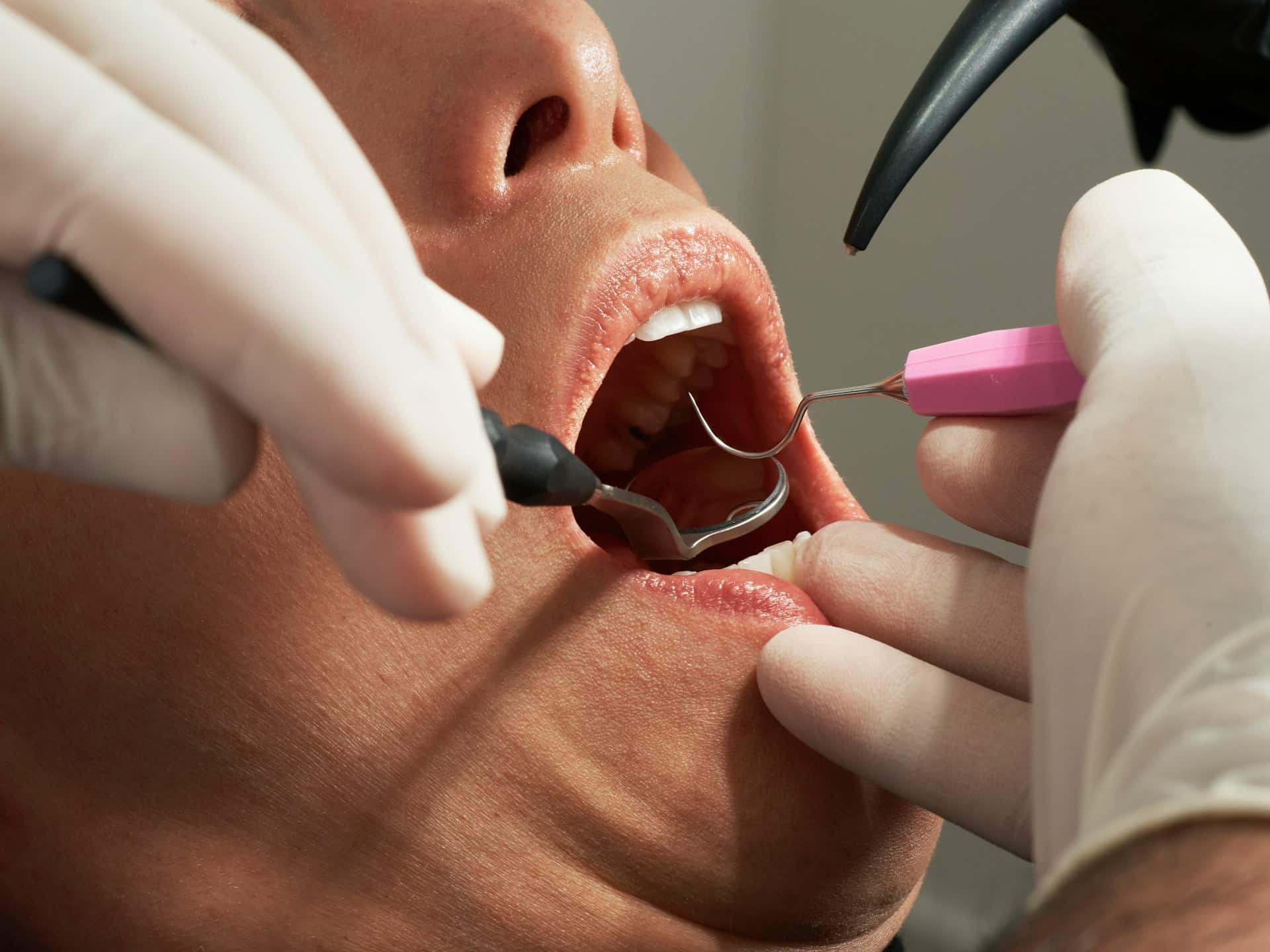 Dental Bridges