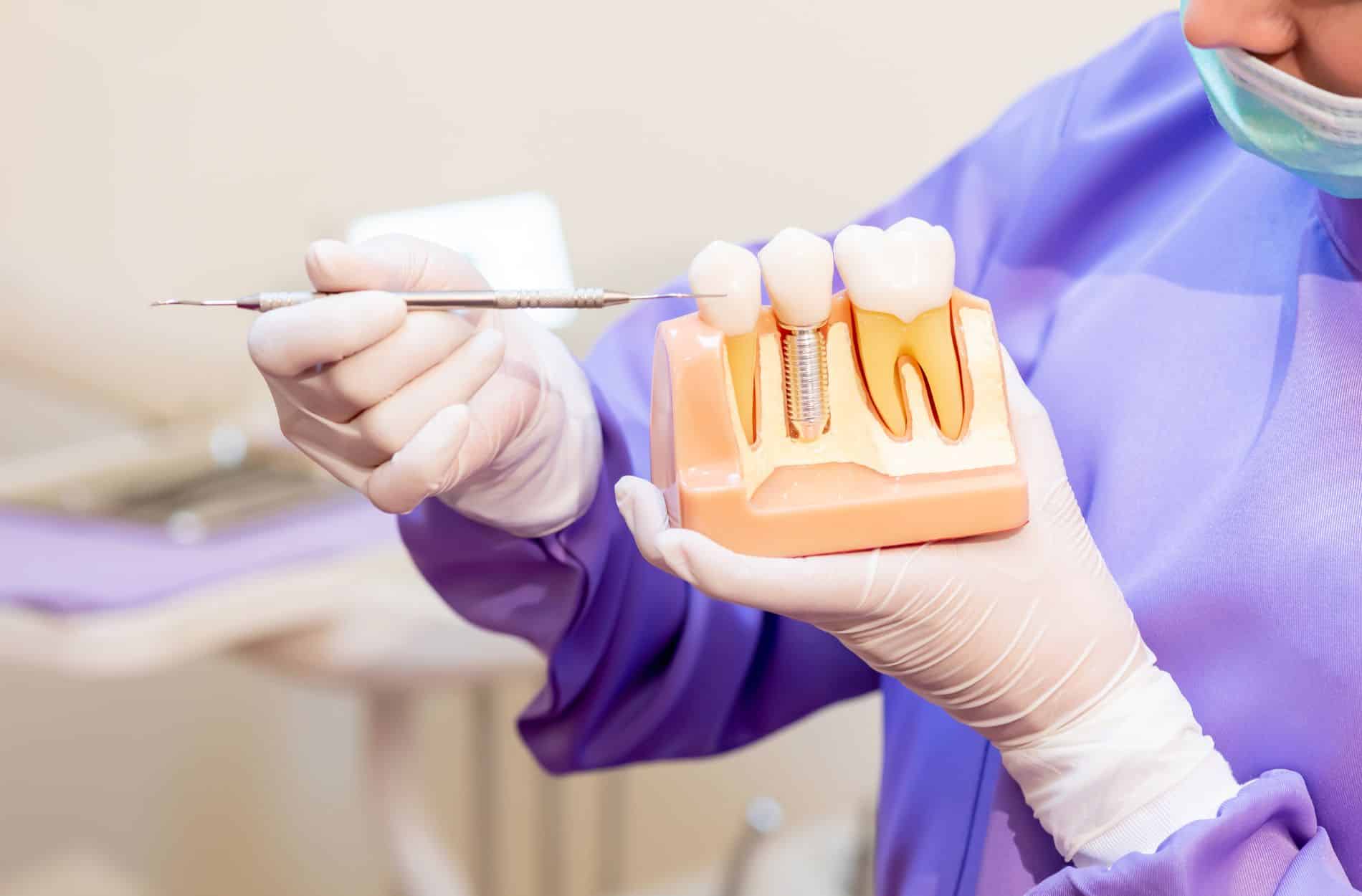 dental implant