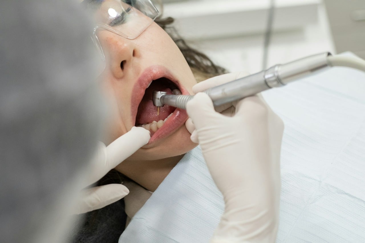 dental bridges