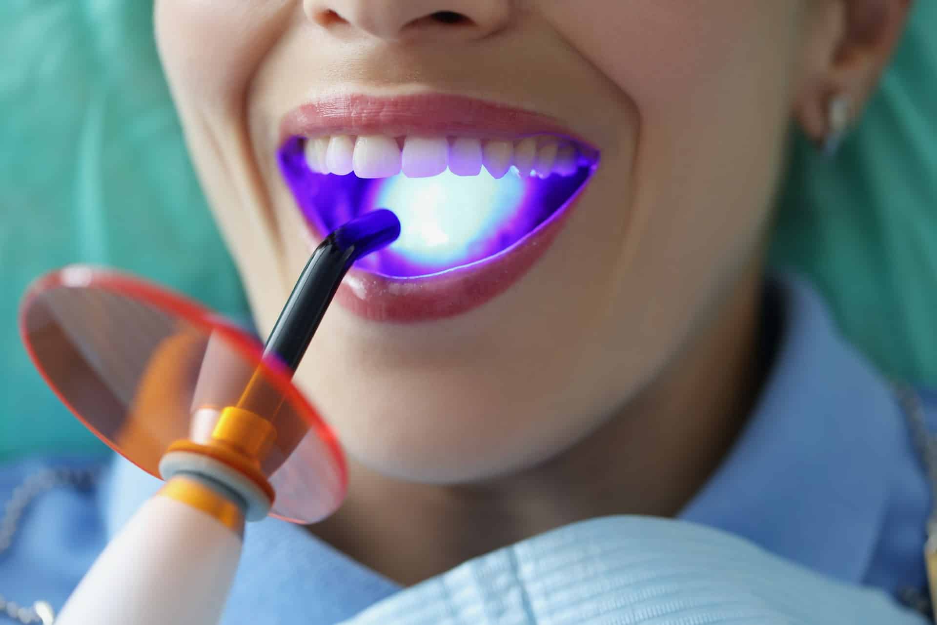tooth-colored fillings
