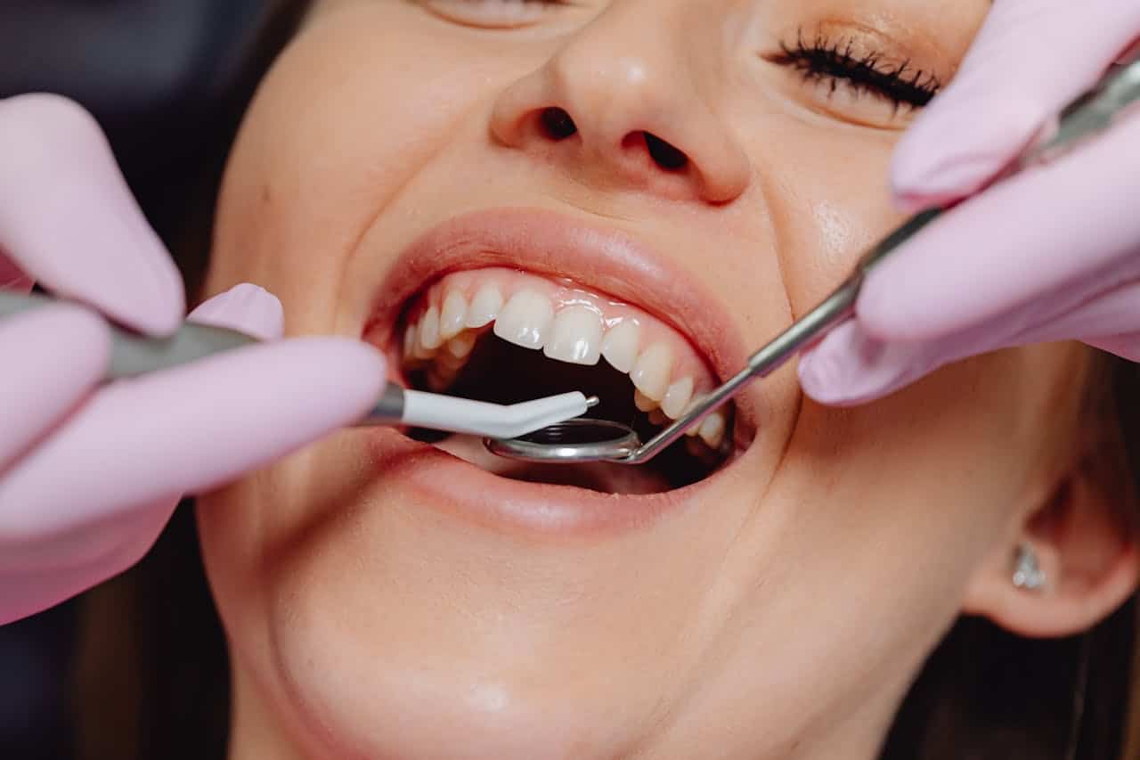 tooth coloured fillings