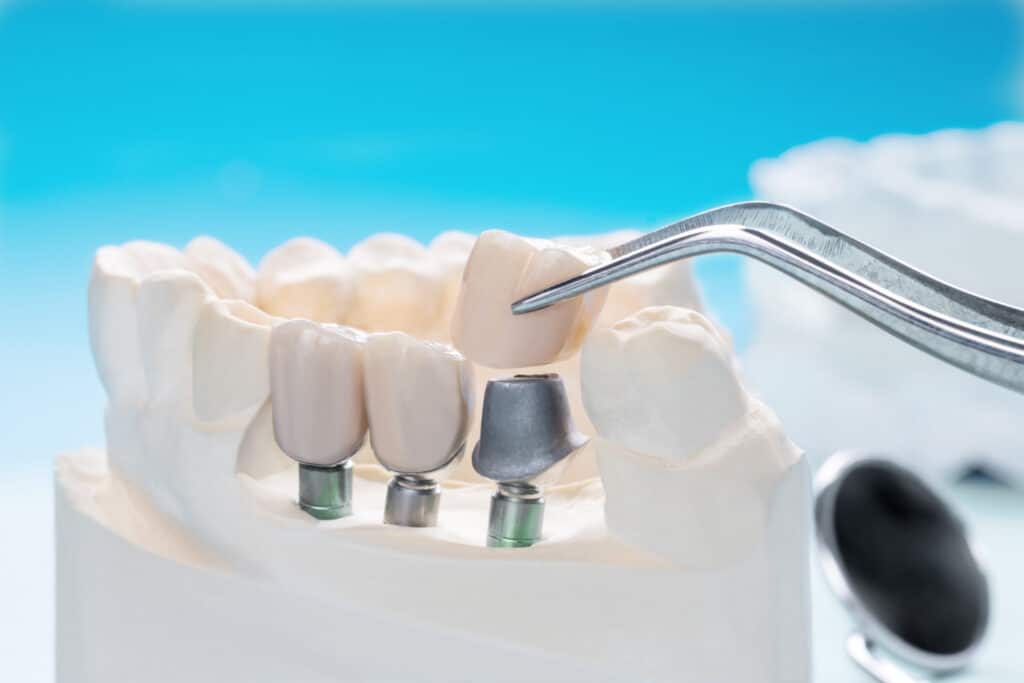 dental implants