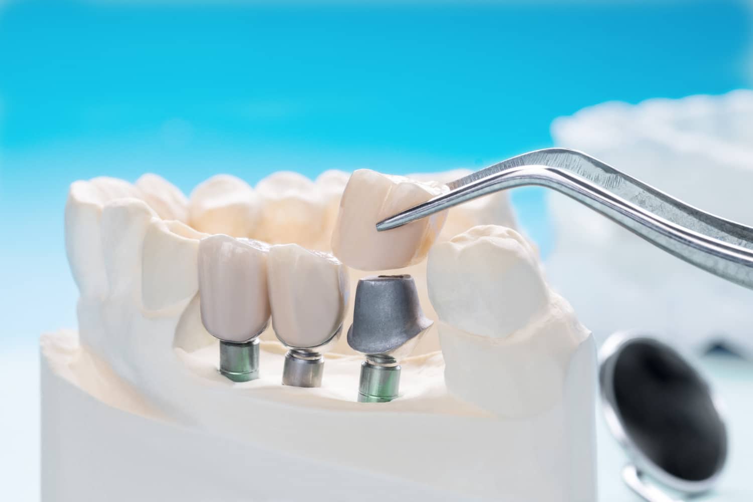 dental implants