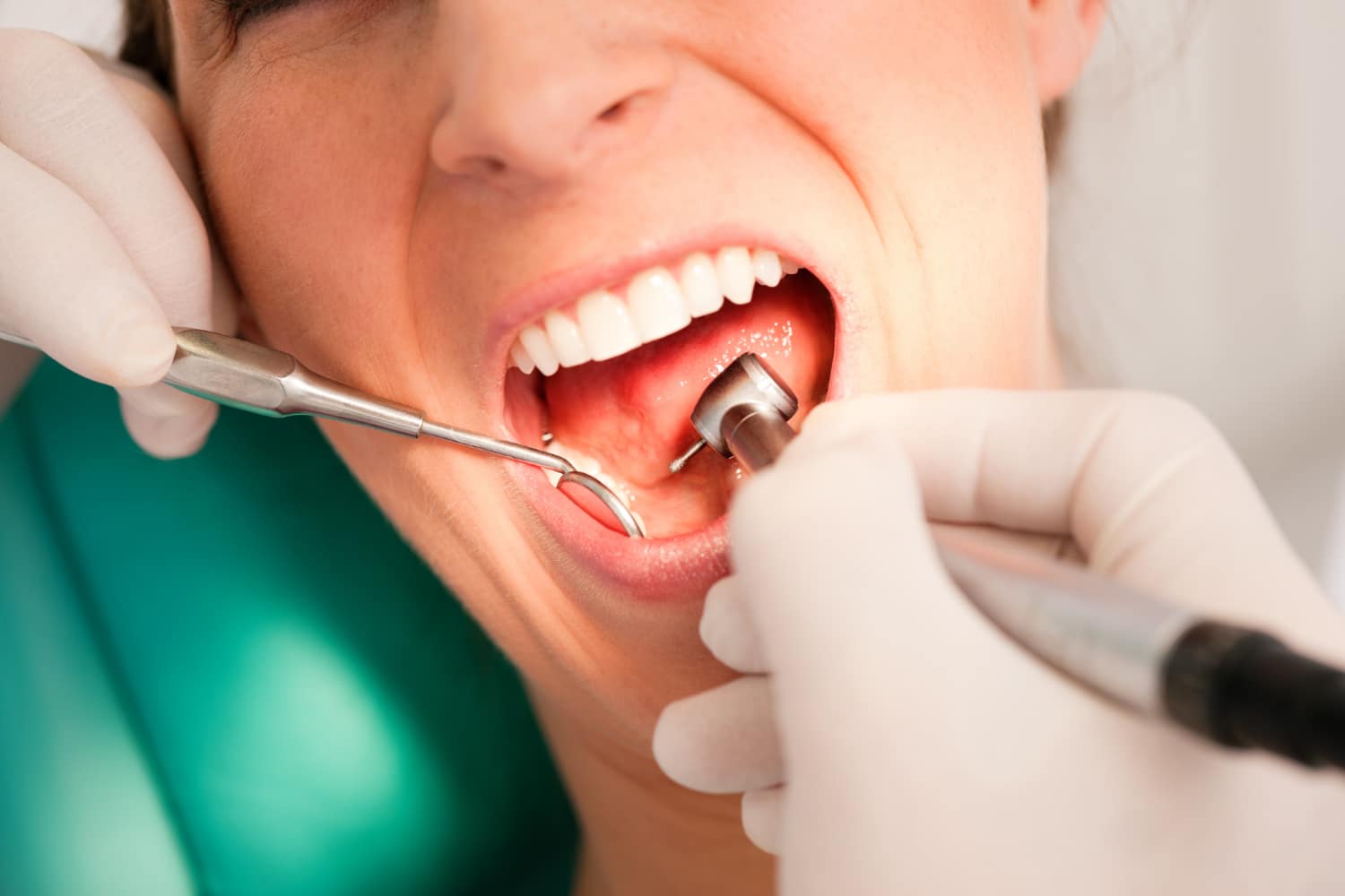 tooth-coloured fillings
