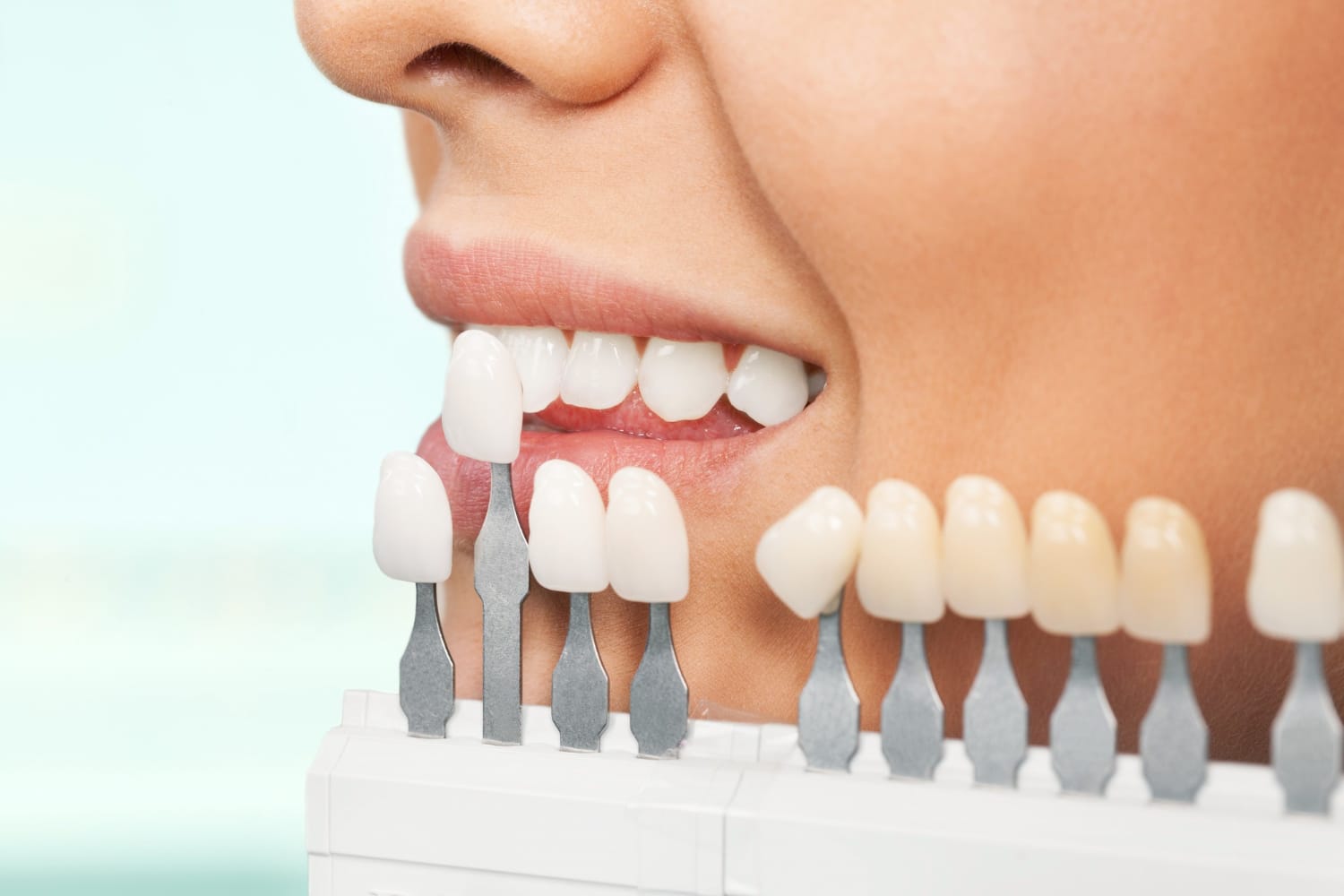 veneers