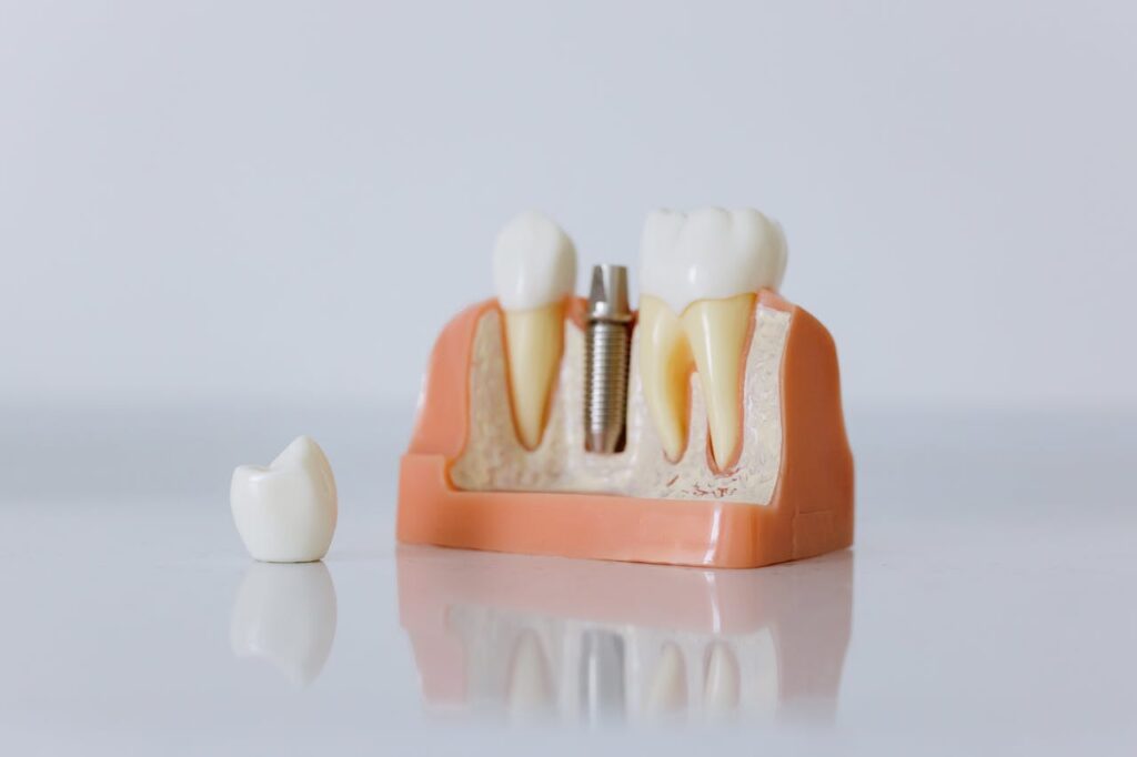 Implant Dentistry