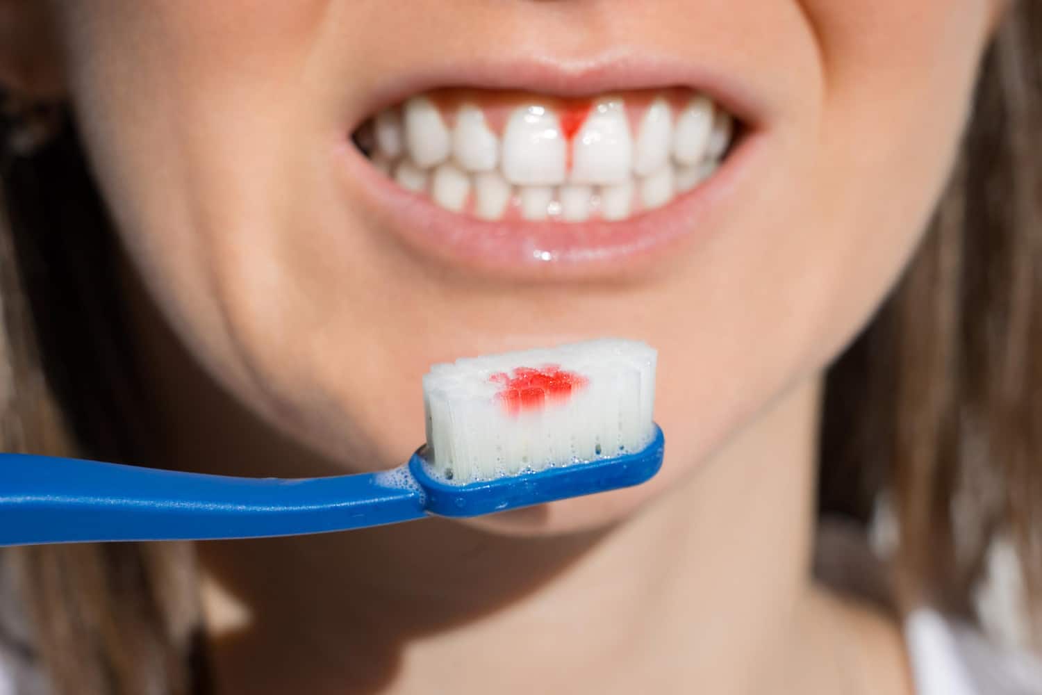 Bleeding When Brushing