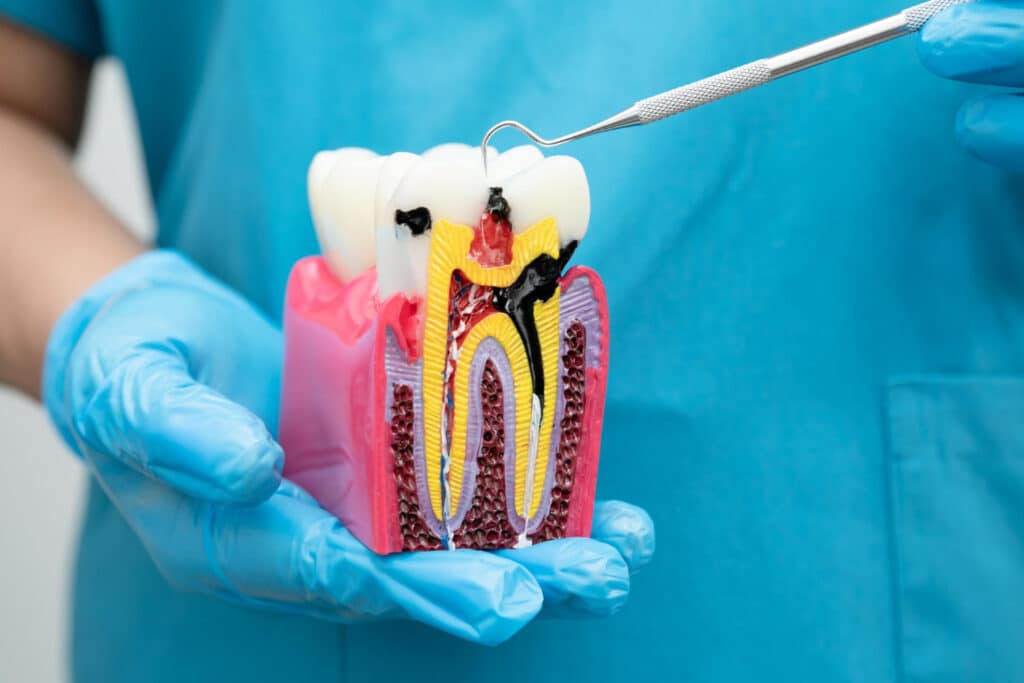 Root Canal