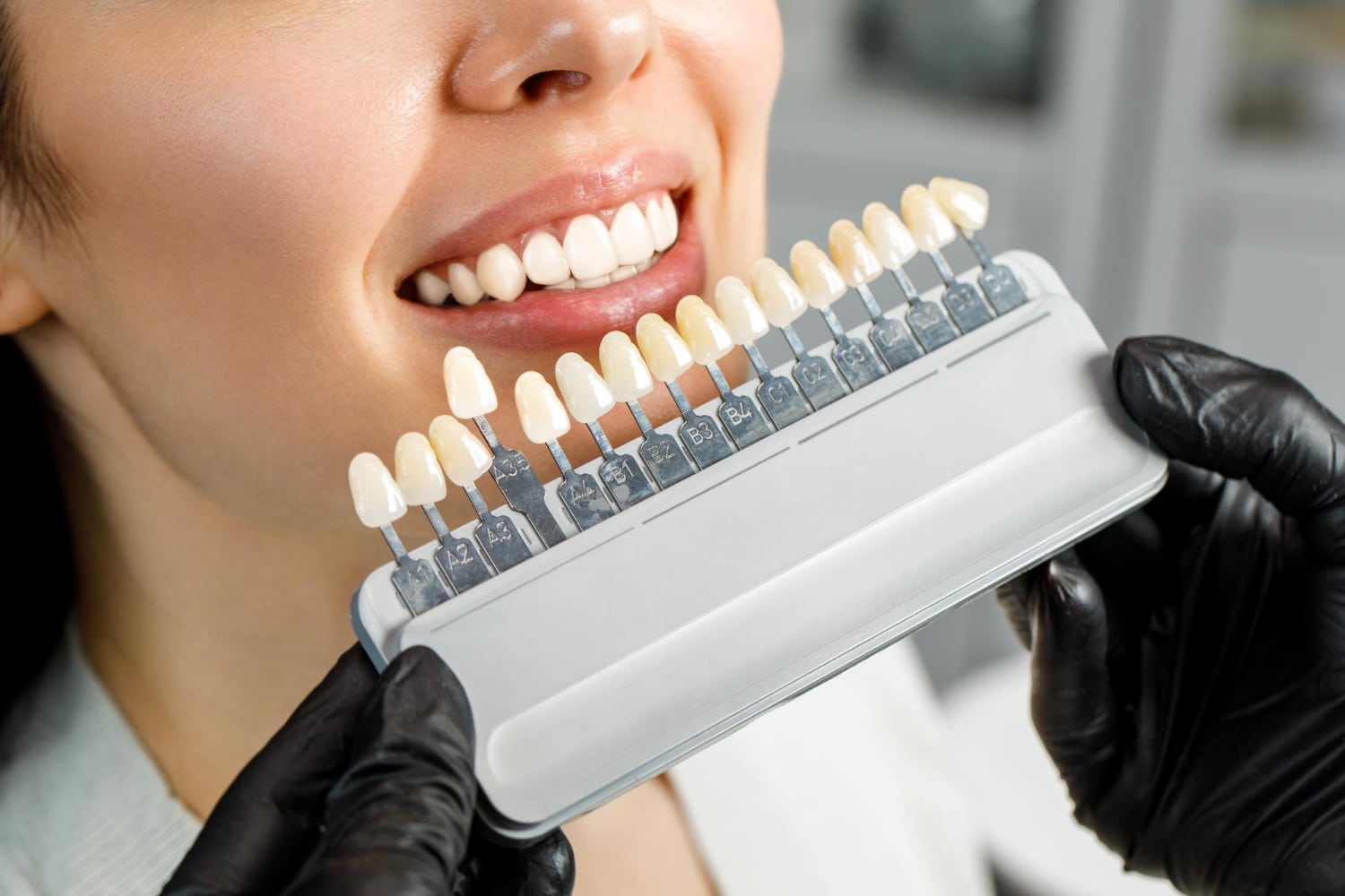 veneers